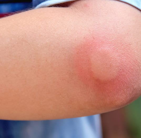 Bald-faced hornet sting reaction on skin